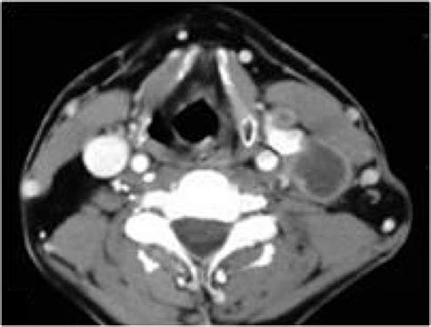 Axial Computed Tomography Scan Of Patient With Left Cervical Metastatic