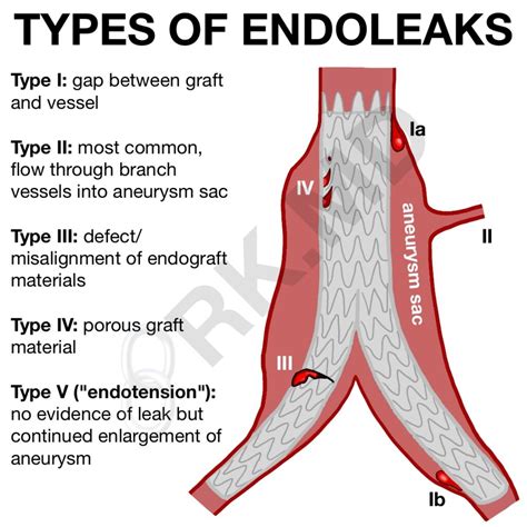 Types Of Endoleaks Rkmd