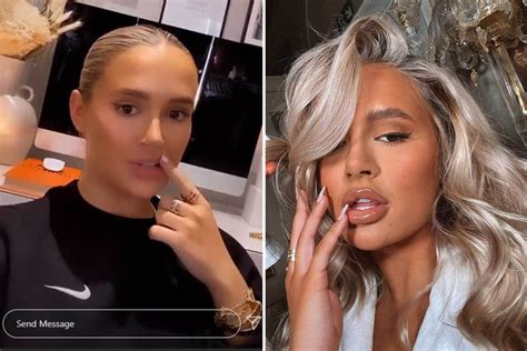 Molly Mae Hague Reveals Her Natural Lips Are Stretched By Fillers