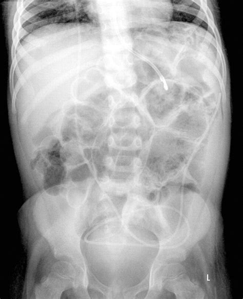 Perforation How To Spot Free Intraperitoneal Air On Abdominal