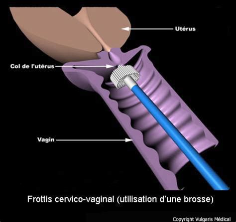 Frottis Cervico Vaginal Technique Utilisant La Brosse Sch Ma