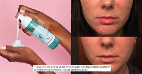 29 Drugstore Skincare Products That Are Actually Amazing Skin Care Acne