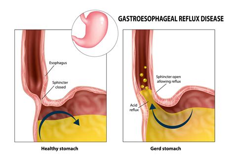 What Is Gastroesophageal Reflux Disease Gerd Painscale