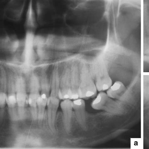 A Panoramic Radiograph Shows A Radiolucent Area With A Radiopaque Focus