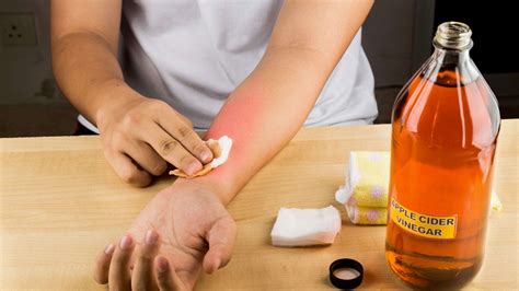 Why You Should Never Treat A Sunburn With Vinegar Business Insider India