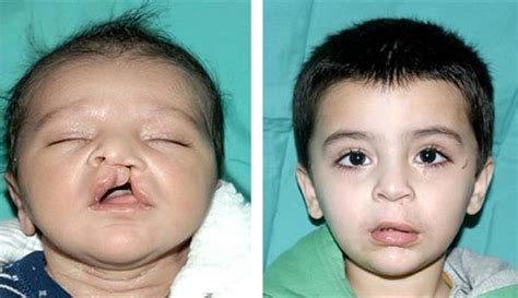 Why Cleft Lip Surgery At 3 Months Cosmetic Surgery Tips