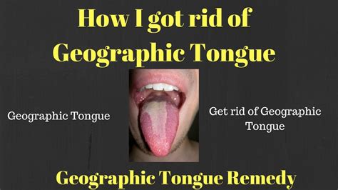 How I Got Rid Of My Geographic Tongue Treating And Beating Geographic