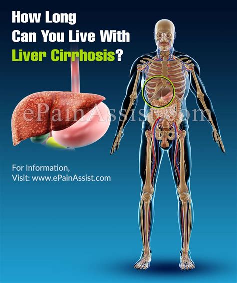 How Long Can You Live With Liver Cirrhosis Cirrhosis Liver Liver
