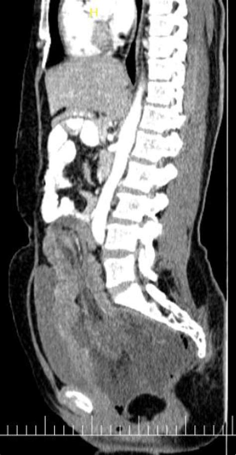 Figure 1 From Colorectal Intussusception With Rectal Prolapse Related To Cecal Lipoma In Adult