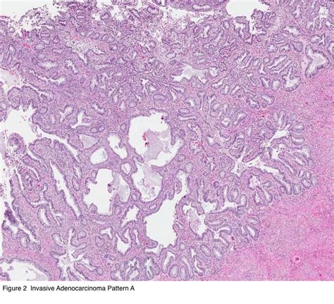 Pathology Outlines Hpv Related Adenocarcinoma Usual Type And Variants