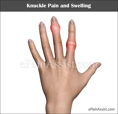What Causes Bumps On Knuckles
