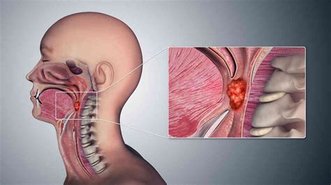 Throat Cancer Causes Symptoms Diagnosis Treatment And Prevention