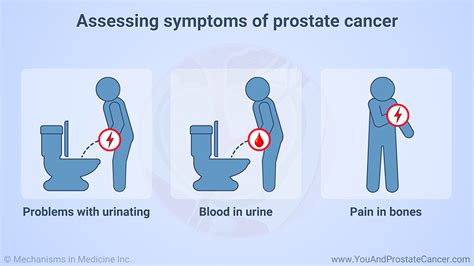 Slide Show Diagnosing Prostate Cancer
