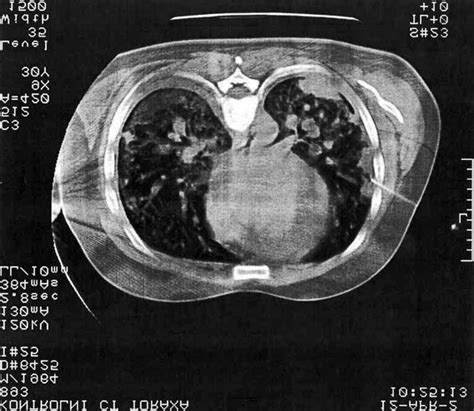 Transverse Computer Tomography Scan CT Of The Chest Obtained During