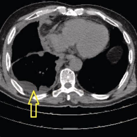 A Hypermetabolic Nodule In The Right Lower Lobe Adjacent To Oblique