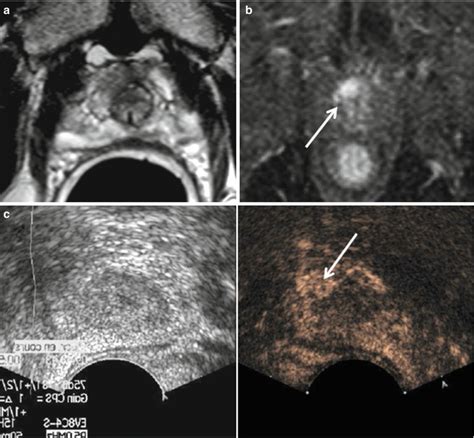 Contrast Enhanced Ultrasound In Prostate Cancer Radiology Key