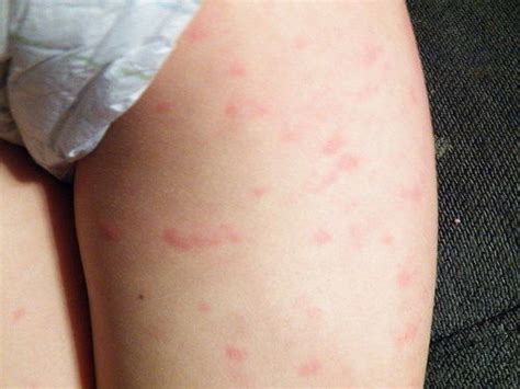 It looks like a measels these pictures of this page are about:rash from laundry detergent. Get Rid From Detergent Allergies - Remedies To Cure ...