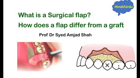 What Is Surgical Flap How Does A Flap Differ From A Graft Oral Surgery Syed Amjad Shah