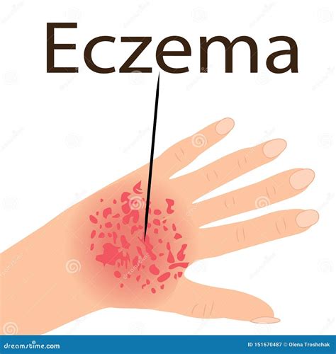 Eczema Affected A Hand Dermatology Skin Disease Stock Vector