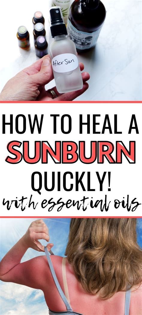 How To Heal Sunburn Fast With Essential Oils Natural Cough