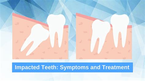 Impacted Teeth Warning Signs And Treatment Ek Dental Surgery