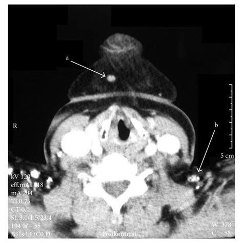 Axial Cervical Ct Image Reveals Absece Of The Right Submandibular Gland