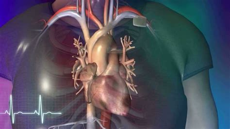 The artificial pacemaker is one of the great medical inventions of the 20th century. maxresdefault.jpg