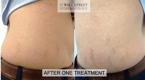Laser Skin Resurfacing Wall Street Dermatology