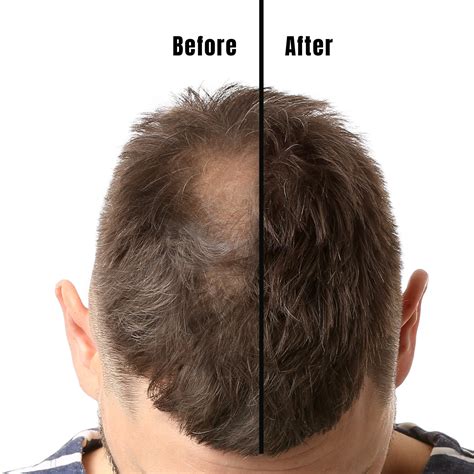 How Long Will Minoxidil Results Take And Minoxidil Before And After