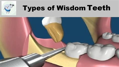 Types Of Wisdom Teeth Removal Youtube