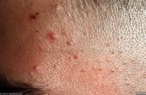 Fungal Skin Rashes In Groin