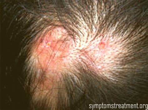 Discoid Lupus Pictures Symptoms Treatment Photos