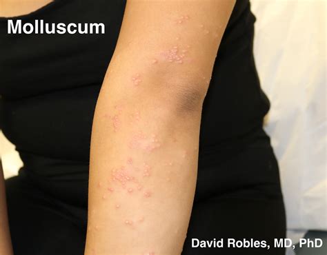 David Robles Md Phd Dermatologist Molluscum Contagiosum Tiny