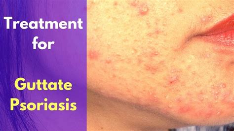🩸 Psoriasis Guttate Treatment For Guttate Psoriasis Youtube