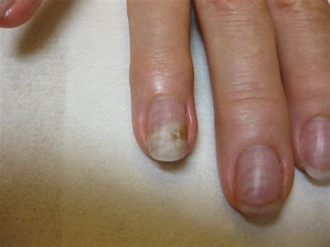 What Do Different Color Nail Fungus Mean The Meaning Of Color