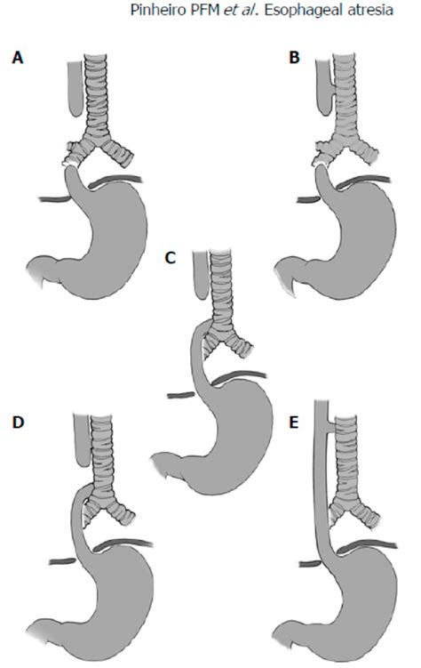 Classification Of Esophageal Atresia Tracheoesophageal Fistula A