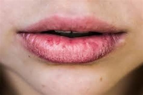 Can Vitamin Deficiency Cause Chronic Chapped Lips My Best Dentists