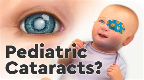 Cataract Surgery In Children Childrens Hospital Colorado