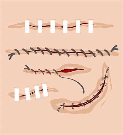 Medical Stitches Illustrations Royalty Free Vector Graphics And Clip Art