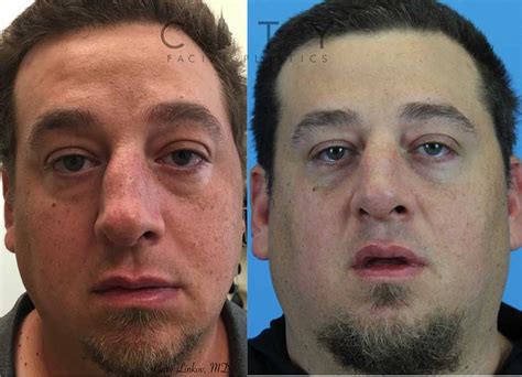 Deviated Septum Surgery Before And After