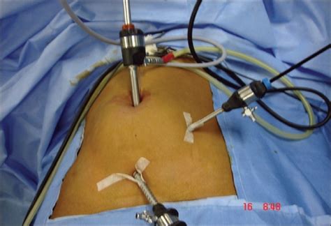 Laparoscopic Appendectomy Port Placement