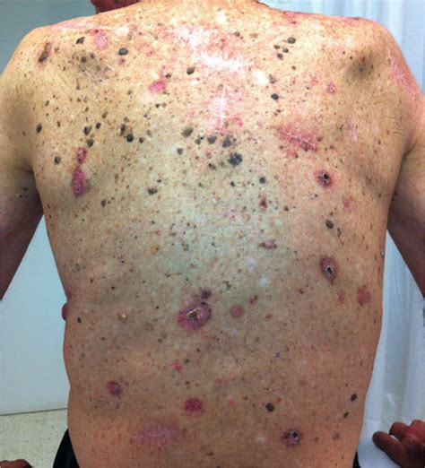 Multiple Skin Cancers Mainly Squamous Cell Carcinomas In A Solid