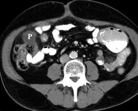 Primary Gastrointestinal Lymphoma Spectrum Of Imaging Findings With