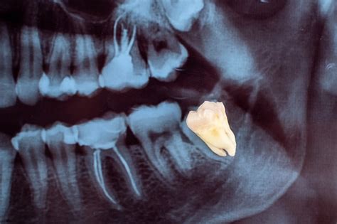 Healing From Wisdom Tooth Extraction Ismile Dental Team Pc