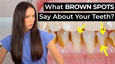 What Do Brown Spots On Your Teeth Mean Youtube
