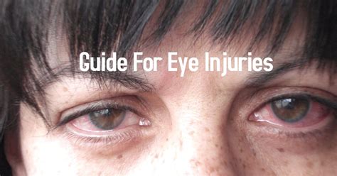 My heart is breaking in front of me. Guide For Eye Injuries - My Life With No Drugs