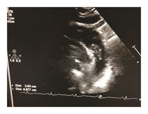 Transesophageal Echocardiography Showed A 23 Mm Mobile Thrombus In The