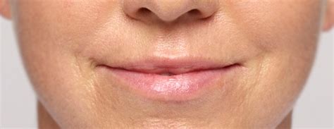 Restylane Silk Get Plump Full Lips And Reduce Small Lines