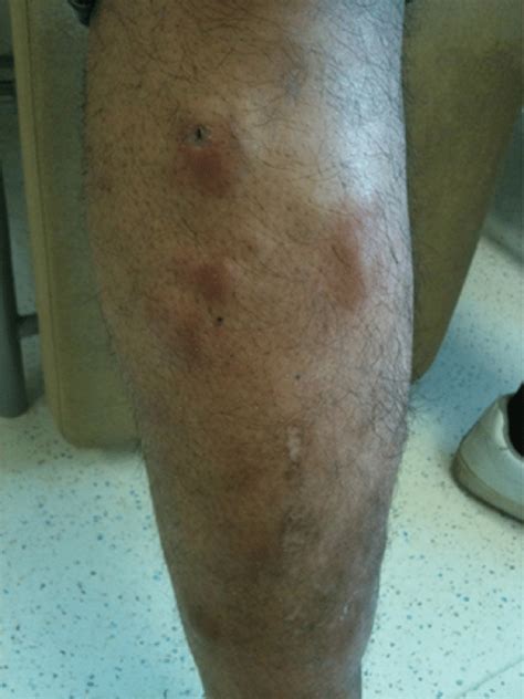 Maculopapularnodular Erythematous Skin Lesions On The Right Leg There