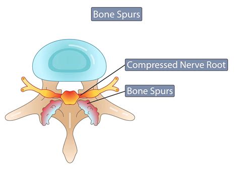 Other locations on the body where an individual might develop a bone spur. Bone Spurs Symptoms & Causes | What is a Bone Spur? | MNC